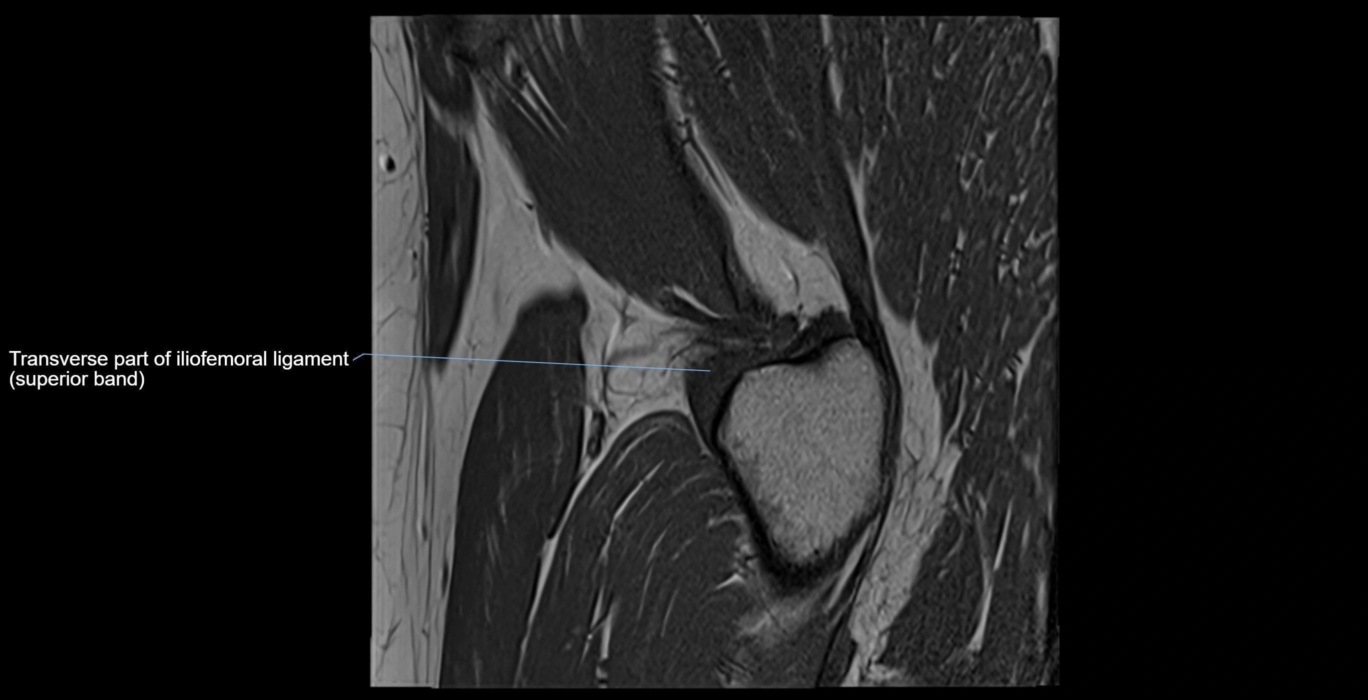 MRI Hip ligaments sagittal cross sectional anatomy 3T  radiology  image-img-00001-00021.webp